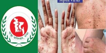 ‘মাঙ্কিপক্স’ সচেতনতায় হটলাইন চালু করল স্বাস্থ্য অধিদপ্তর।