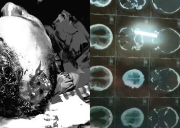 রামপালে তাপবিদ্যুৎ কেন্দ্রের চোরাই সিন্ডিকেটের চাপাতির কোপে ব্যবসায়ী বিল্লাল আহত।