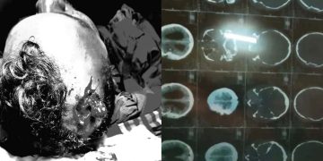 রামপালে তাপবিদ্যুৎ কেন্দ্রের চোরাই সিন্ডিকেটের চাপাতির কোপে ব্যবসায়ী বিল্লাল আহত।