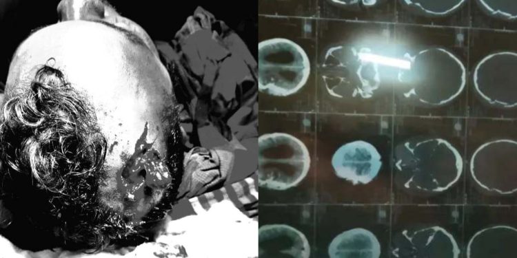 রামপালে তাপবিদ্যুৎ কেন্দ্রের চোরাই সিন্ডিকেটের চাপাতির কোপে ব্যবসায়ী বিল্লাল আহত।