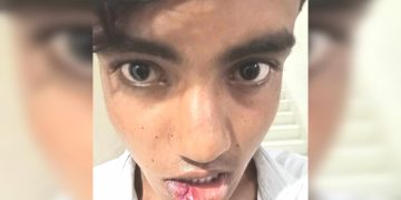 রামপালে কিশোর আহতের ঘটনায় মামলা হয়নি।